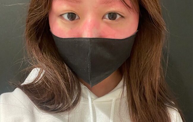 【衝撃】AKB48吉橋柚花さん、眉毛を染めてアレルギーでとんでもない顔になってしまう・・・【ゆず恋】
