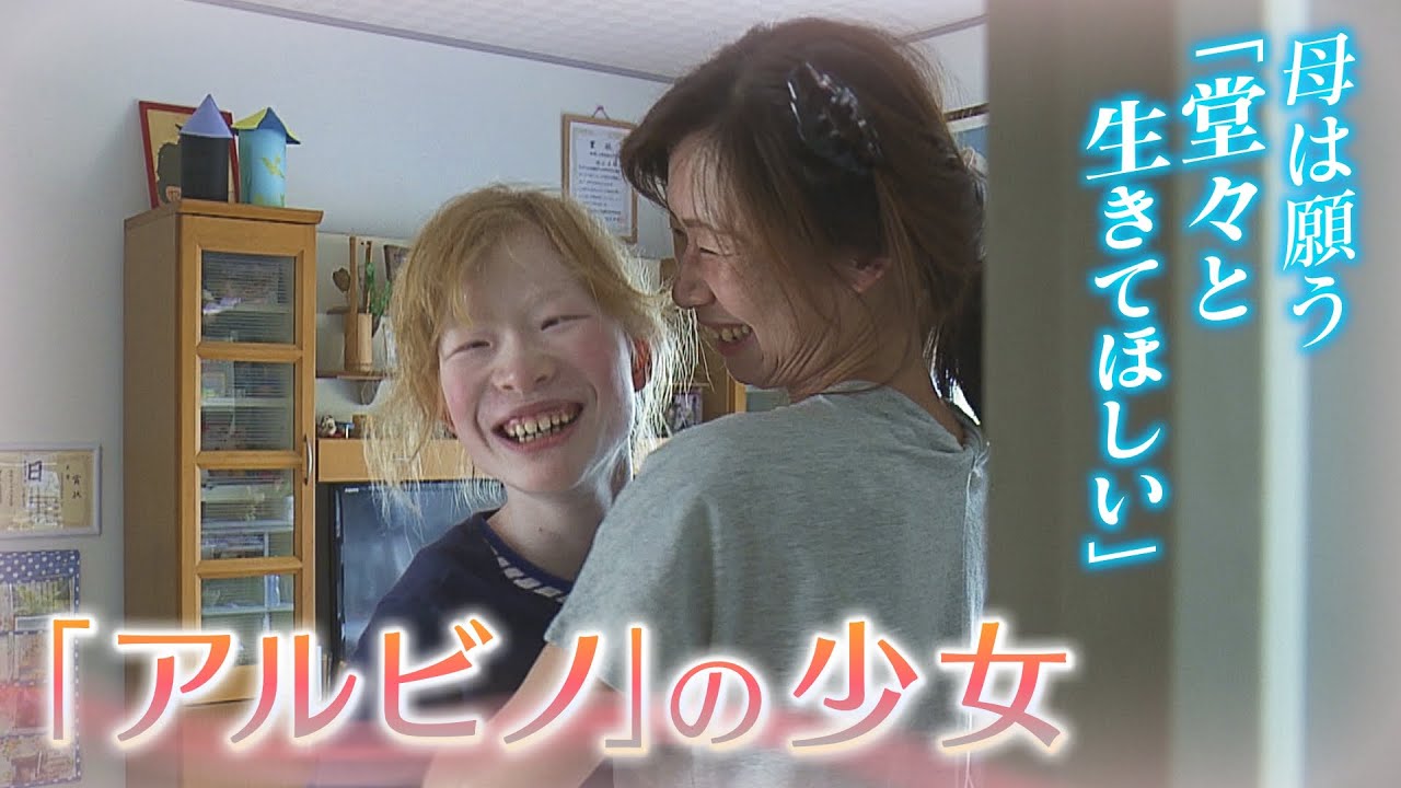 【アルビノに生まれて】白い肌に金髪の少女 『堂々と生きて』と願う母(2019年7月3日)