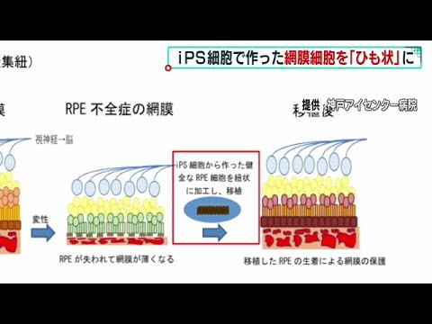 ｉＰＳ細胞から作った網膜の細胞を“ひも状”にして患者に移植　臨床研究を開始へ（2022年2月19日）