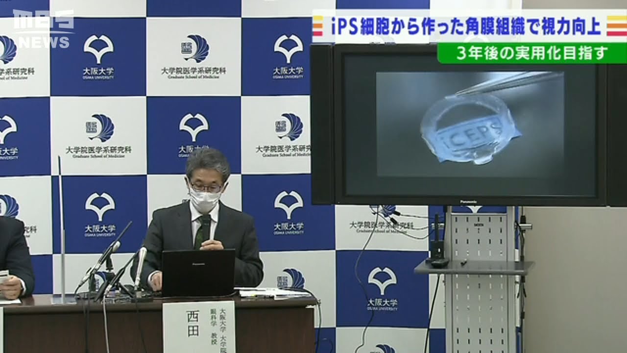 【視力回復の患者も】『ｉＰＳ細胞から作製の角膜組織』を移植する手術成功し安全性を確認　世界初の臨床研究　大阪大学(2022年4月5日)