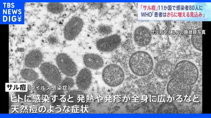 「サル痘」の患者が11か国に拡大　患者さらに増える見込み　ＷＨＯが警戒呼びかけ｜TBS NEWS DIG