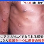 欧米で相次ぐ「サル痘」全国の自治体に“疑い患者”の情報提供を求める　後藤厚労大臣｜TBS NEWS DIG