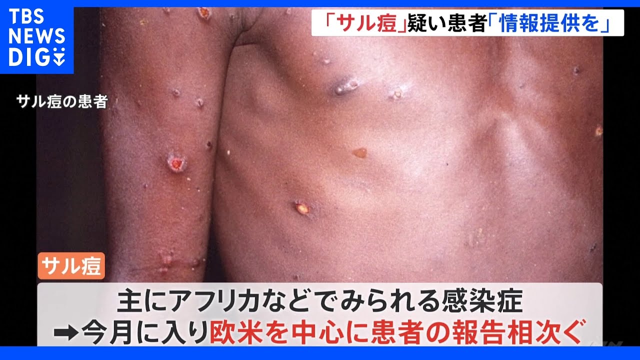 欧米で相次ぐ「サル痘」全国の自治体に“疑い患者”の情報提供を求める　後藤厚労大臣｜TBS&nbsp;NEWS&nbsp;DIG