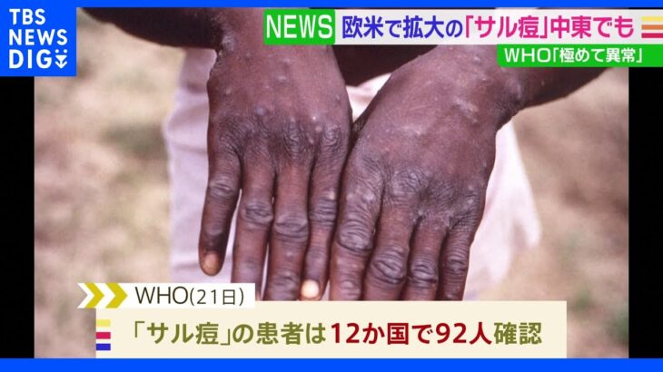 “サル痘”中東でも初確認　WHO「極めて異常だ」｜TBS NEWS DIG
