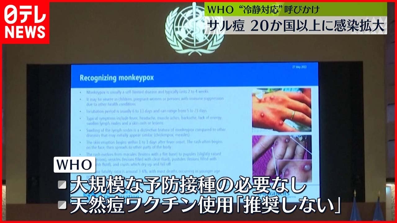 【サル痘】WHO「サル痘」20か国以上に拡大　“冷静な対応”呼びかけ