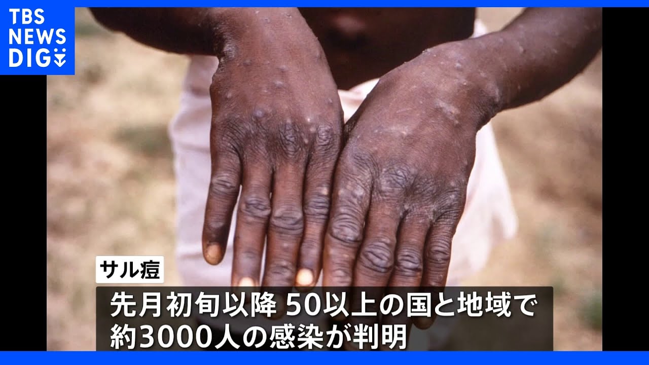 WHO&nbsp;サル痘「緊急事態」にはあたらないと判断｜TBS&nbsp;NEWS&nbsp;DIG