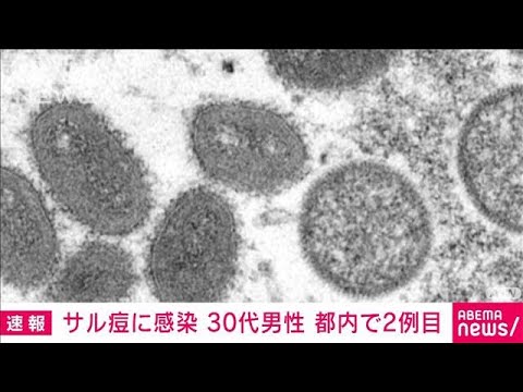 【速報】東京都内で2例目のサル痘患者　海外渡航歴ある30代の男性で入院中(2022年7月28日)