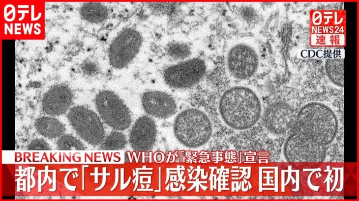【速報】東京都内で「サル痘」感染者を確認 国内初