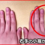 【スマホ指】長時間の利用で…傷みや指の“変形”も