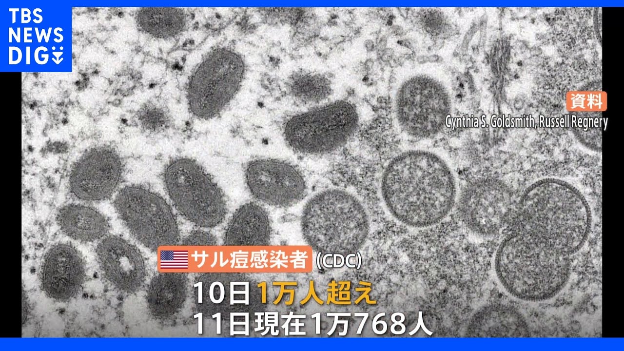サル痘拡大で非常事態宣言のアメリカ　感染者1万人超える&nbsp;｜TBS&nbsp;NEWS&nbsp;DIG
