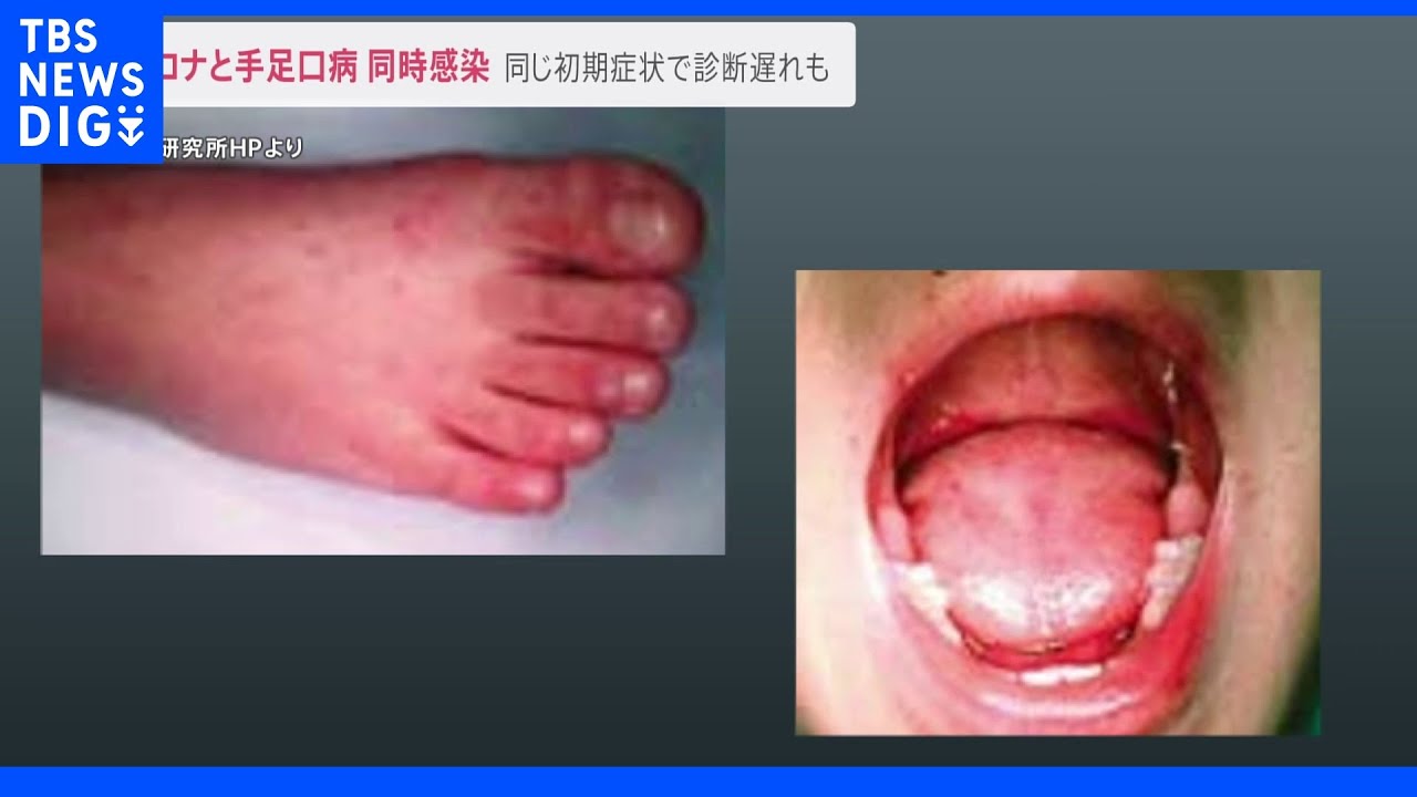 子どもが手足口病とコロナに“同時感染”…コロナの全国死者は最多343人に「全数把握」見直しに賛否の声も｜TBS&nbsp;NEWS&nbsp;DIG