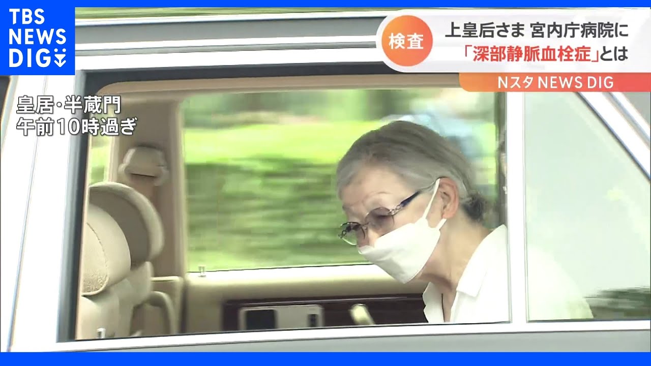 上皇后　美智子さま&nbsp;宮内庁病院に&nbsp;「深部静脈血栓症&nbsp;末梢型」とは&nbsp;｜TBS&nbsp;NEWS&nbsp;DIG