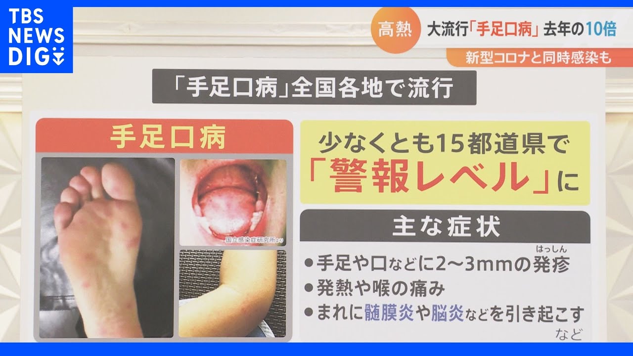 すでに“警報レベル！”全国各地で、子どもたちが感染する「手足口病」。&nbsp;患者数は去年の10倍！新型コロナと同時に感染も…｜TBS&nbsp;NEWS&nbsp;DIG
