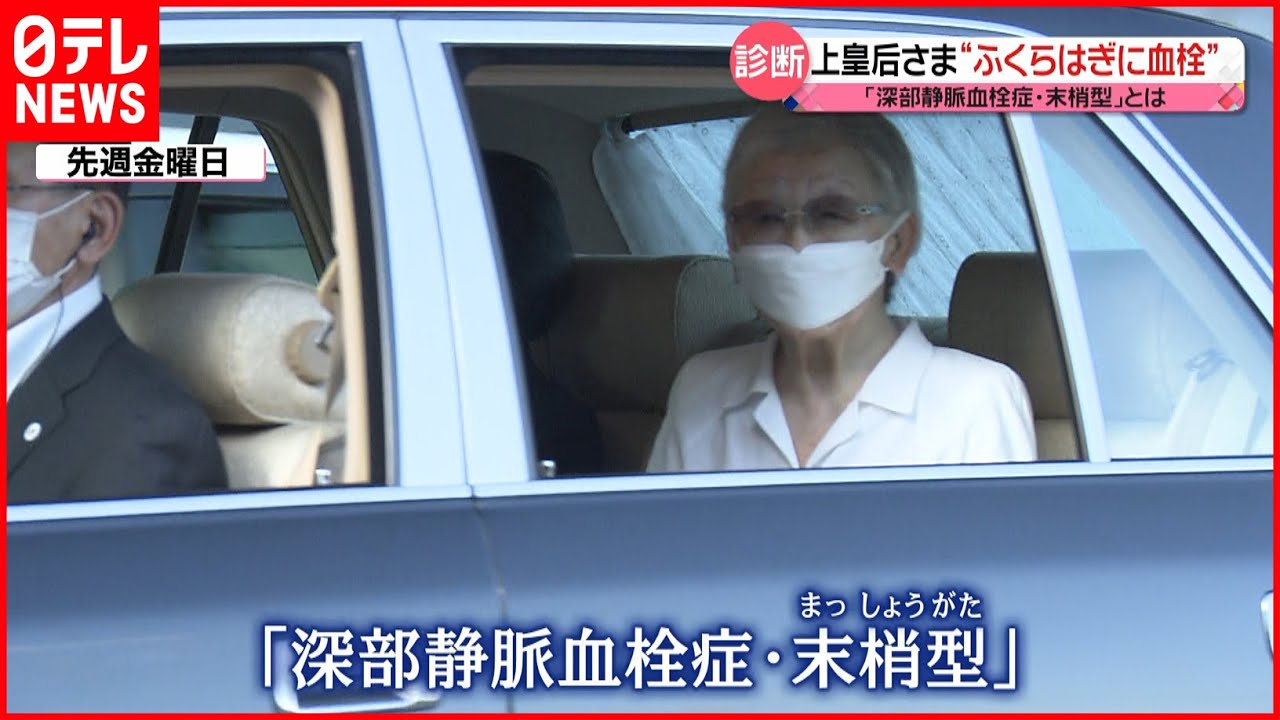 【上皇后さま】“右足ふくらはぎに血栓”で検査受けられる 専門家「足の血栓を放っておくと、脳梗塞になる人もいる」
