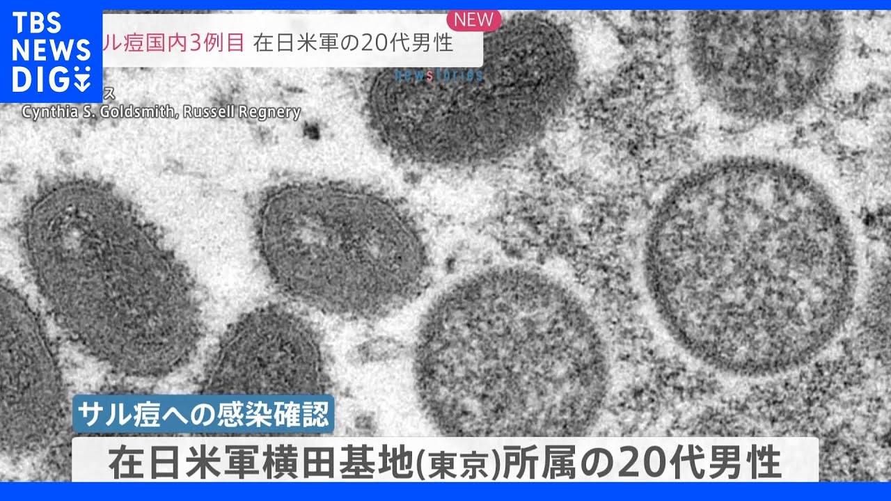 サル痘　国内3例目　東京・横田飛行場で米軍関係者の男性｜TBS&nbsp;NEWS&nbsp;DIG