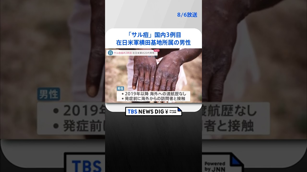 サル痘 国内3例目 東京・横田飛行場で米軍関係者の男性 #shorts ｜TBS NEWS DIG