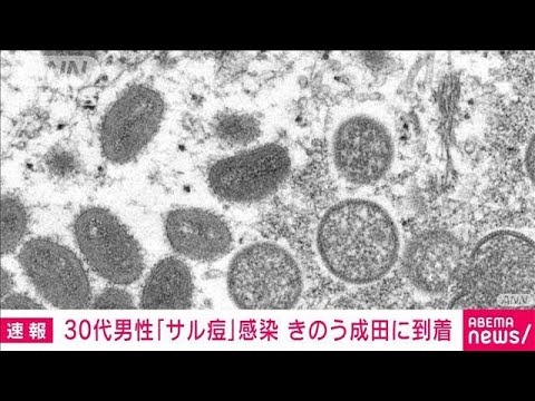【速報】成田空港に到着の欧州在住30代男性がサル痘に感染　発疹が出て検疫所で申告(2022年8月10日)