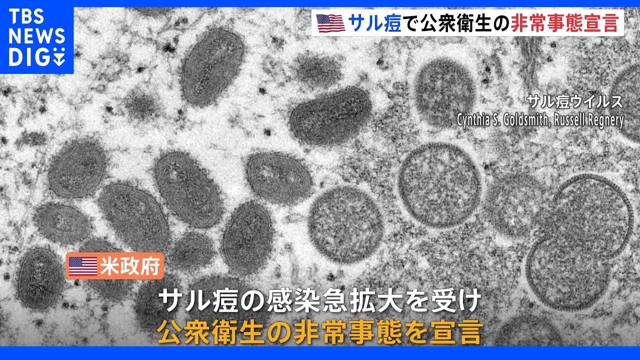 サル痘の新規感染者が3日間で1300人以上　アメリカで公衆衛生の非常事態を宣言｜TBS&nbsp;NEWS&nbsp;DIG
