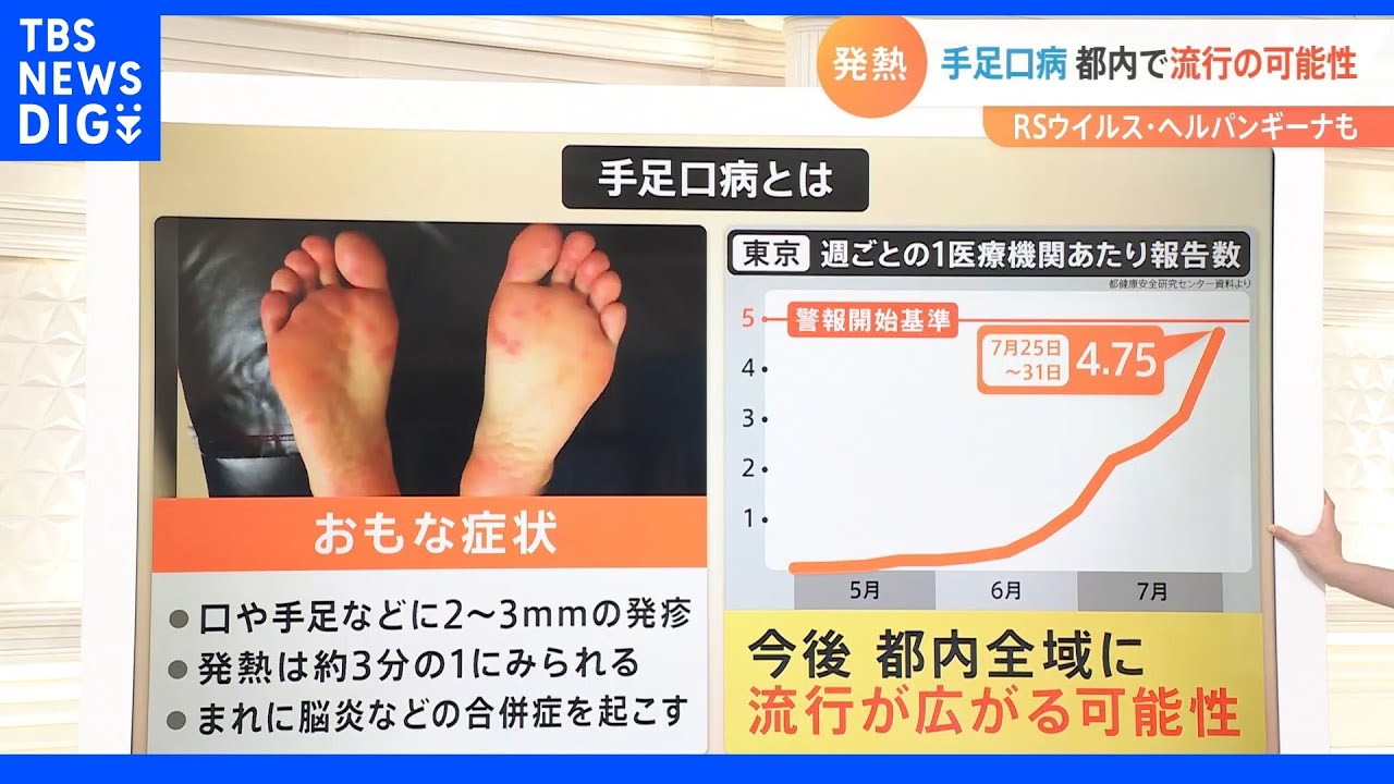 「手足口病」「RSウイルス」なども増加傾向…コロナだけじゃない“こどもの発熱”　親が注意すべきポイントは？医師が解説｜TBS&nbsp;NEWS&nbsp;DIG