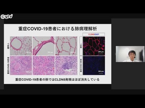 コロナが血管内に侵入するメカニズムを解明　重症化を防ぐ治療薬開発につながる期待　京大など