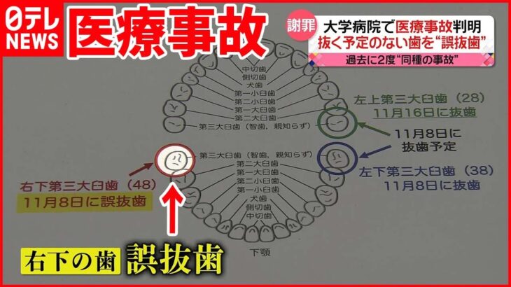 【医療事故】大学病院で抜く予定のない歯を“誤抜歯” 患者からの投書で発覚