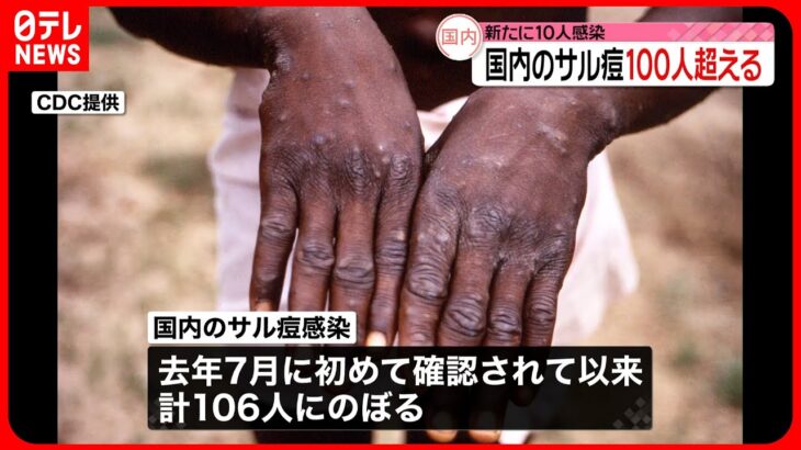 【国内のサル痘感染者】100人超える これまで全て男性…1月以来急増