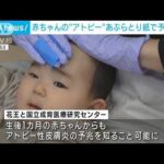 赤ちゃんの「アトピー性皮膚炎」 “あぶらとり紙”で検査可能に(2023年4月13日)