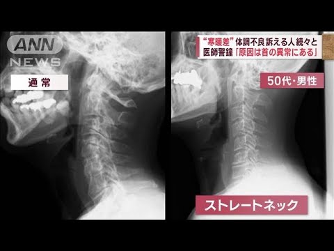 “寒暖差”体調不良　訴える人続々と　医師警鐘「原因は首の異常にある」　(2023年5月23日)