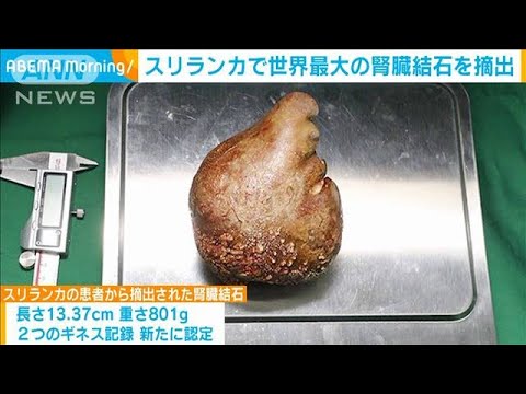 ギネス記録 世界最大の腎臓結石を摘出スリランカ(2023年6月16日)