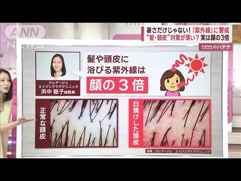 “紫外線”が薄毛、白髪の原因に？「髪・頭皮」は顔の3倍…医師に聞く(2023年7月27日)