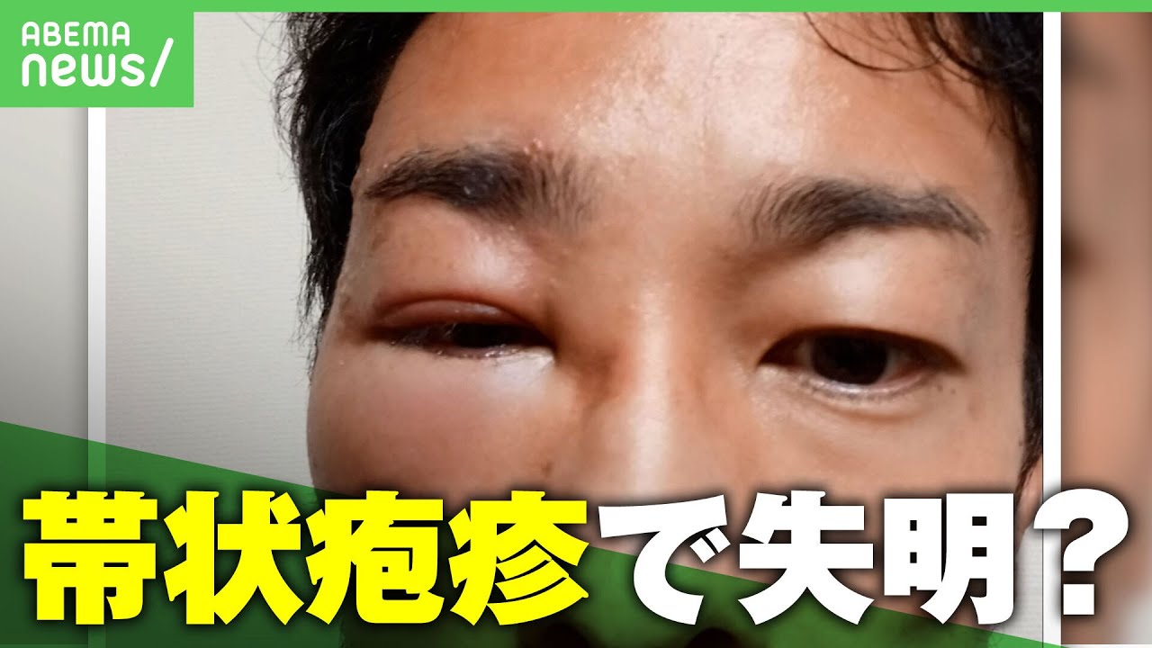 【注意】帯状疱疹で“失明”の危機？「目の奥の神経が壊されていた」原因や予防策は？眼科医に聞く｜アベヒル