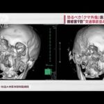 医師が語る恐るべき「クマ外傷」　頭被害9割“交通事故並み衝撃”(2023年11月10日)