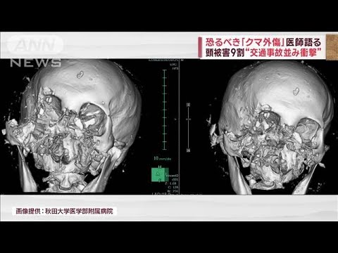 医師が語る恐るべき「クマ外傷」　頭被害9割“交通事故並み衝撃”(2023年11月10日)