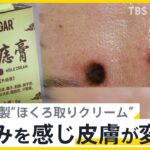 「安全かつ効果的にホクロ除去」を謳う海外製“ほくろ取りクリーム”で皮膚が変色…国民生活センターは使用中止呼びかけ【news23】｜TBS NEWS DIG