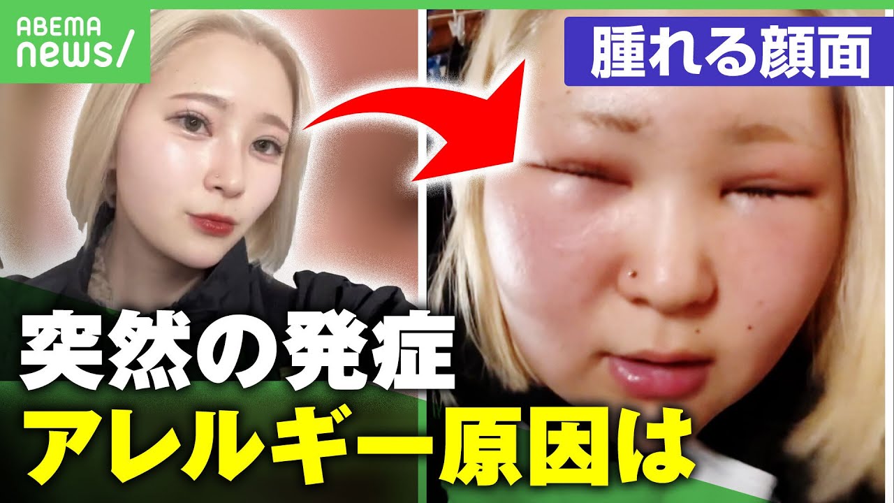 【ブリーチアレルギー】人気TikTokerを襲った”顔の腫れとかゆみ” ヘアカラーで突然発症…進行すると呼吸器症状や嘔吐も｜アベヒル