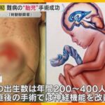 先天性難病の胎児の手術　阪大が日本初の成功「海外ではあった選択肢、日本でも提供できる体制を」