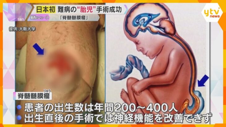 先天性難病の胎児の手術　阪大が日本初の成功「海外ではあった選択肢、日本でも提供できる体制を」