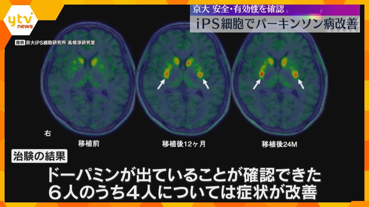 iPS細胞でパーキンソン病改善　臨床試験で安全性と有効性確認「治してなんぼ」厚労省に承認申請へ　京大