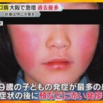 【警戒】「死産や流産の可能性」『リンゴ病』大阪府で過去最多、妊婦は特に注意を　『百日せき』も増加