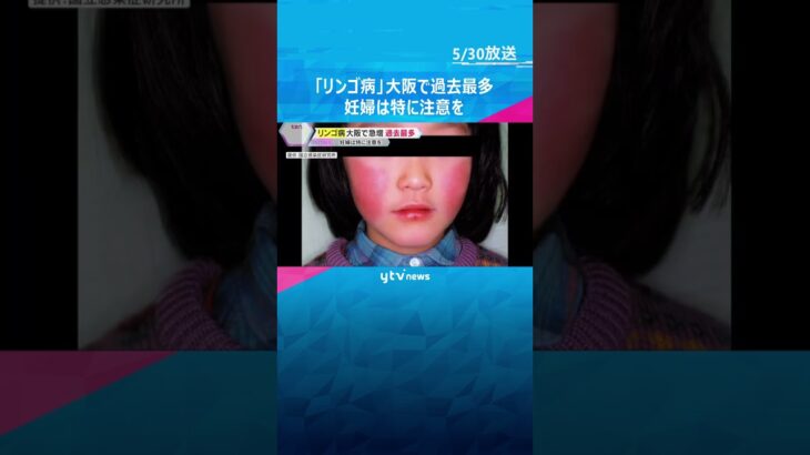 【警戒】「死産や流産の可能性」『リンゴ病』大阪府で過去最多、妊婦は特に注意を　『百日せき』も増加　#shorts #読売テレビニュース