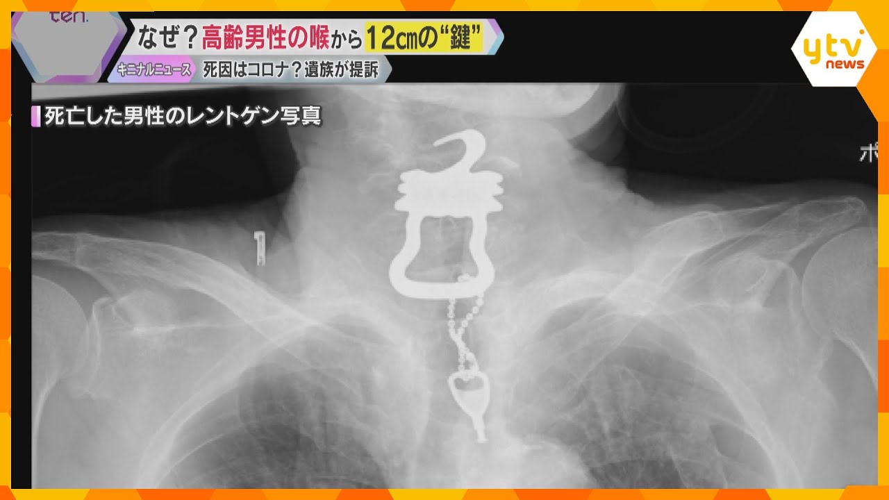 高齢男性の喉から12センチの「鍵」 死因はコロナ？遺族が提訴　病院側は誤飲と死亡の因果関係認めず