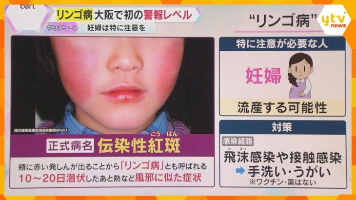 大阪府で「リンゴ病」過去最多の患者数、初の警報レベルに　妊婦は特に注意！手洗いやうがいなど対策を