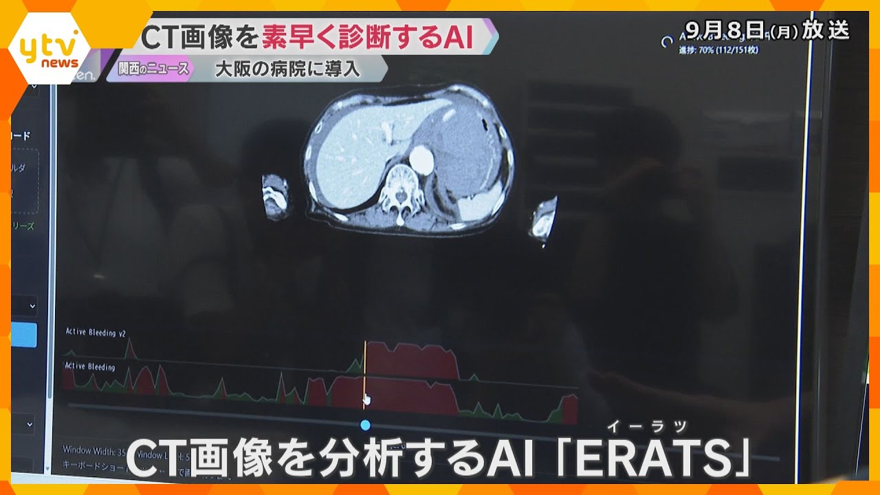 医療現場に初導入　医師が救急救命現場で診断した患者の膨大なCT画像　AIで異常検知
