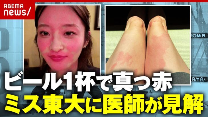 【神谷明采】飲酒で顔が真っ赤に…ミス東大の投稿に心配の声「アレルギーじゃない？」医師が見解｜ABEMA的ニュースショー