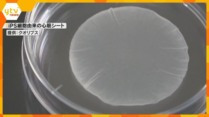 iPS細胞使った心臓病患者のための心筋細胞シート　秋ごろ販売開始へ　大阪大学発のベンチャー企業