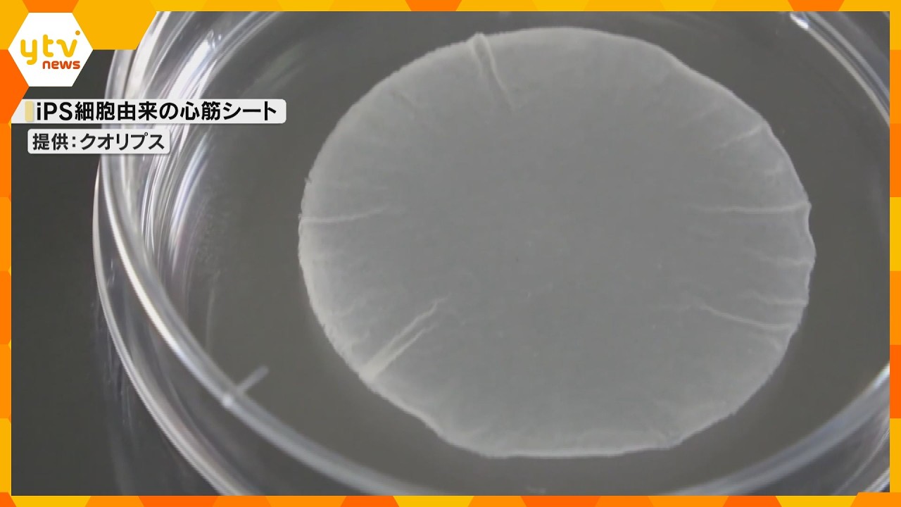 iPS細胞使った心臓病患者のための心筋細胞シート　秋ごろ販売開始へ　大阪大学発のベンチャー企業