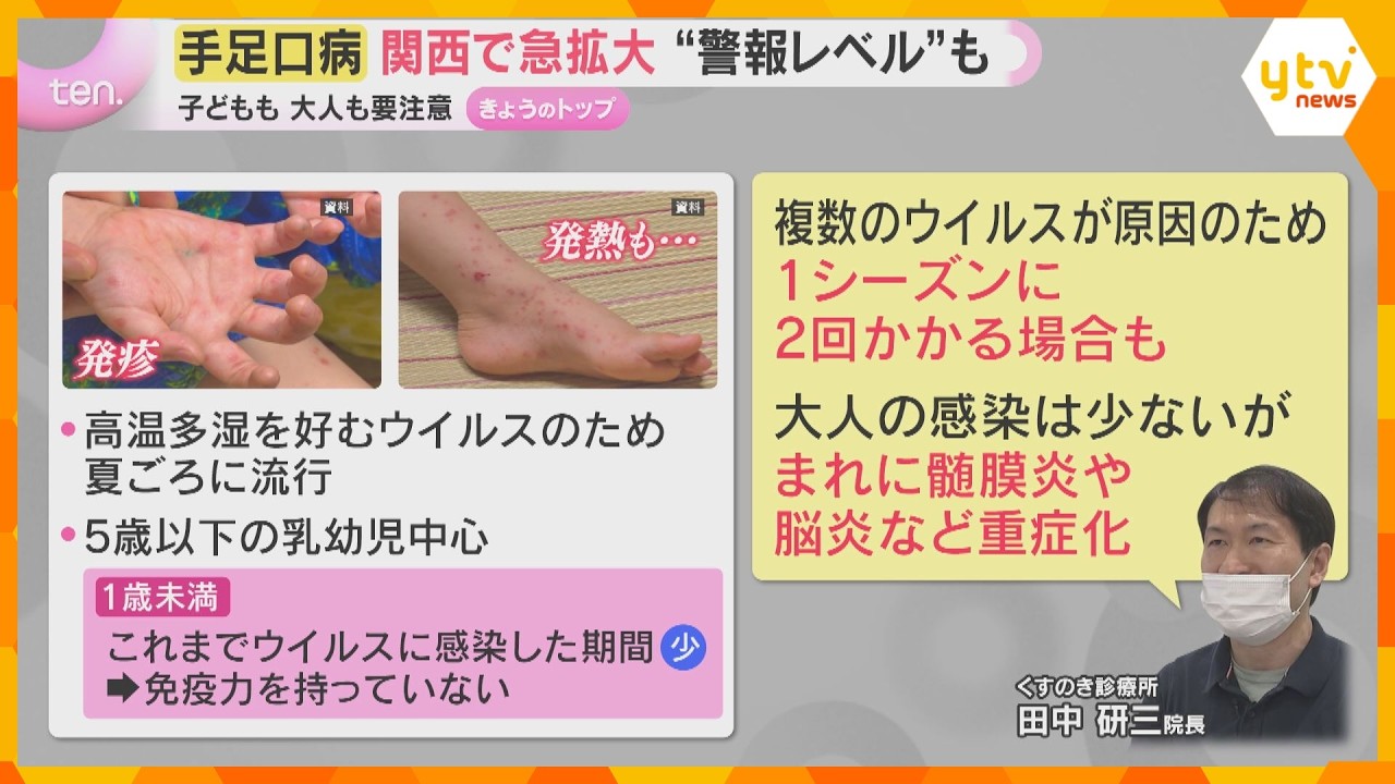 【解説】急拡大する手足口病 乳幼児中心に感染増加で夏場に警戒 大人は重症化恐れ…感染対策の徹底を